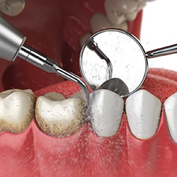 Illustration of plaque being removed from teeth