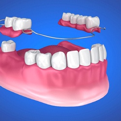 Digital model of partial denture