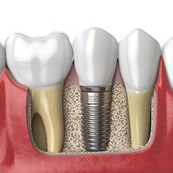 Diagram of an integrated dental implant