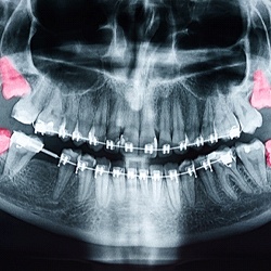 X-ray showing four impacted wisdom teeth in Arlington, TX