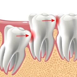 Wisdom tooth in Arlington, TX pushing against molars