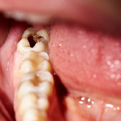 a person with a severely decayed tooth