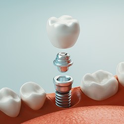 Diagram showing dental implant post abutment and crown