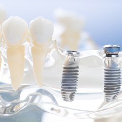 dental implant model