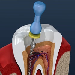 root canal illustration