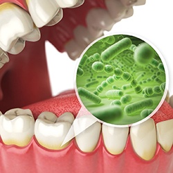 Model of tartar buildup and gum disease.