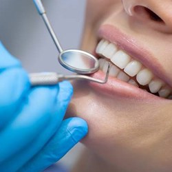 dental cleaning