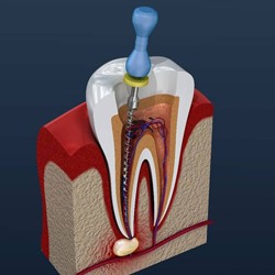 root canal therapy