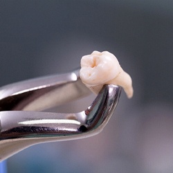 Holding tooth in forceps after wisdom tooth extraction in Arlington, TX