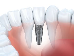 dental implants in arlington