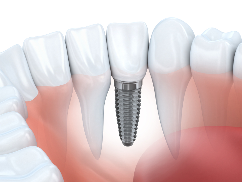 dental implants in arlington