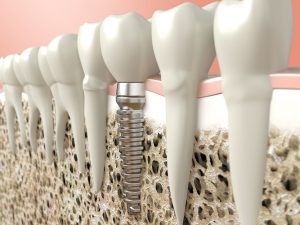 Representation of dental implant