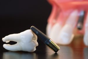 dental implant and tooth