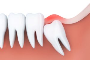 Model of patient needing wisdom tooth removal. 