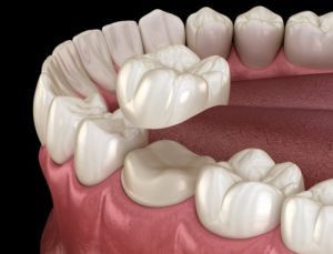 3D illustration of a dental crown 