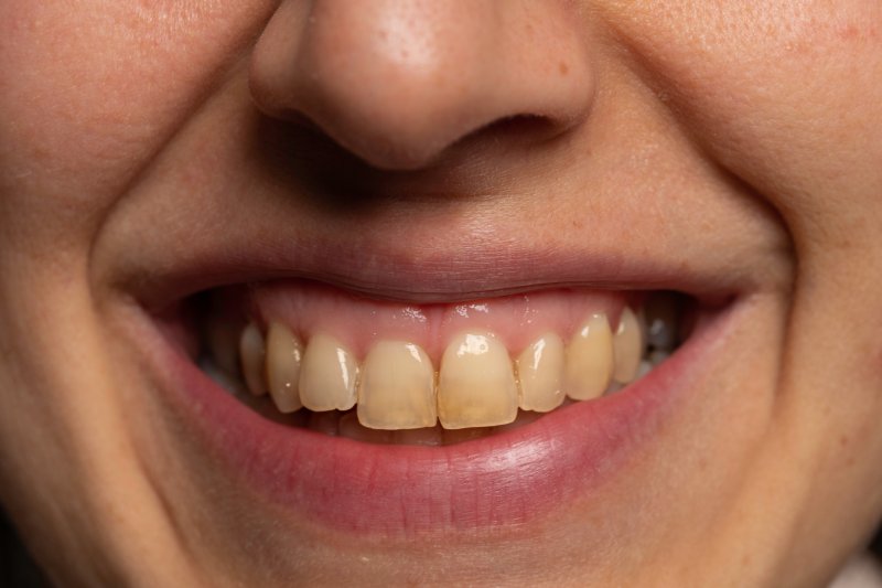 A person with genetically yellow teeth thinking about a teeth whitening treatment