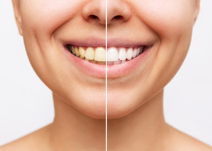 Half white, half yellow smile